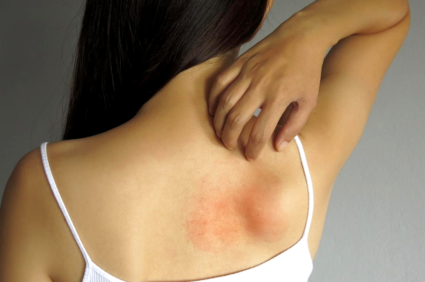 What are the of causes hives? | What are the symptoms of hives? | How long do hives last? | When to seek medical treatment for hives? | How are the hives treated and cured? | Various pictures of hives | diseases that cause hives in adults male and female | what are the Causes of hives in female adults | Can hives be a sign of something serious diseases |Various treatment of hives | How to cure hives fast and quick | Pictures of hives rash on legs and hand